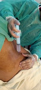 Pain Management Islamabad Procedure in Multan